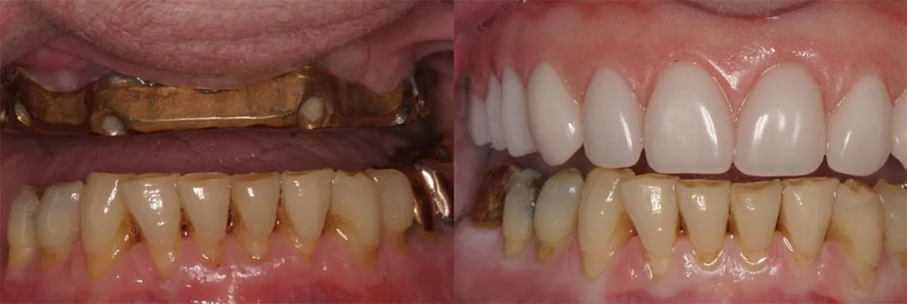 Full Mouth Reconstruction Dentist Near Me