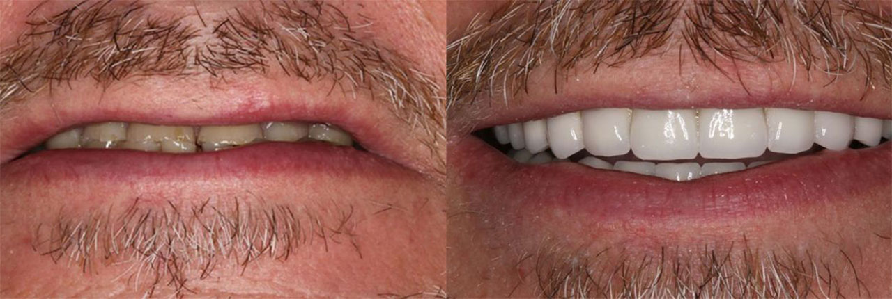 Full Mouth Reconstruction Dentist Near Me