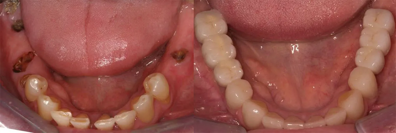 Full Mouth Reconstruction West Michigan