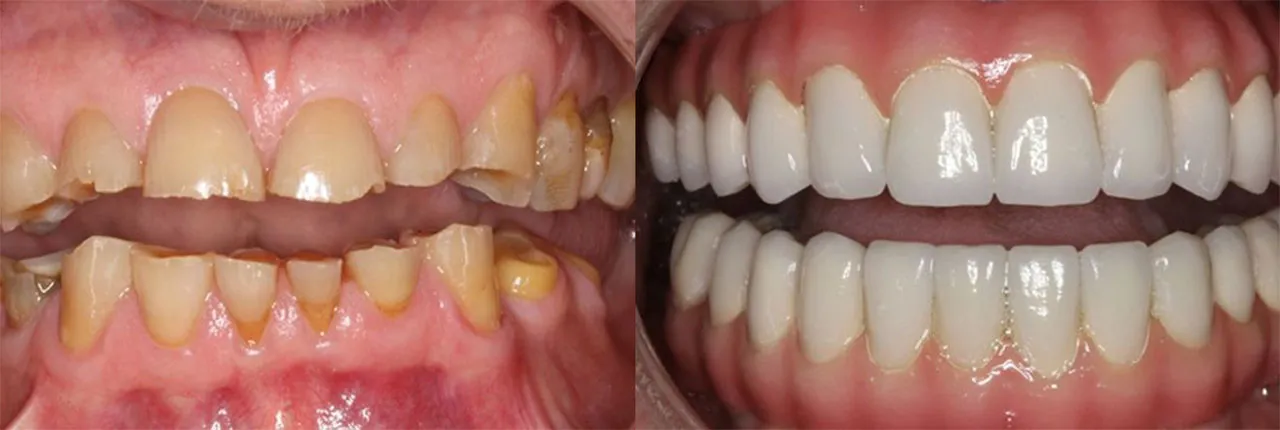 Greater Kalamazoo Full Mouth Reconstruction