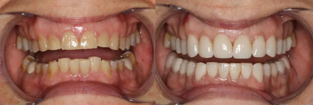 Greater Kalamazoo Veneer Dentists