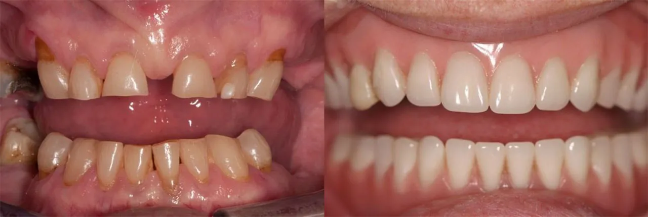 Portage Mi Full Mouth Reconstruction