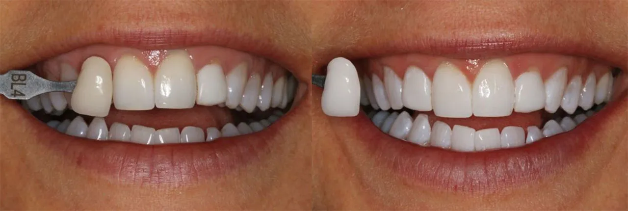 Teeth Whitening Dentists Portage Mi