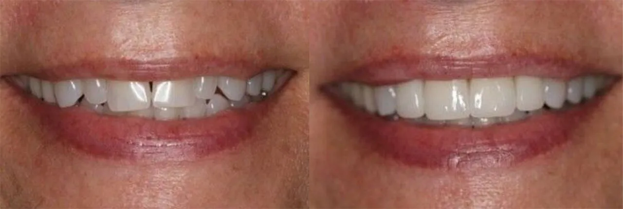 West Michigan Porcelain Veneers